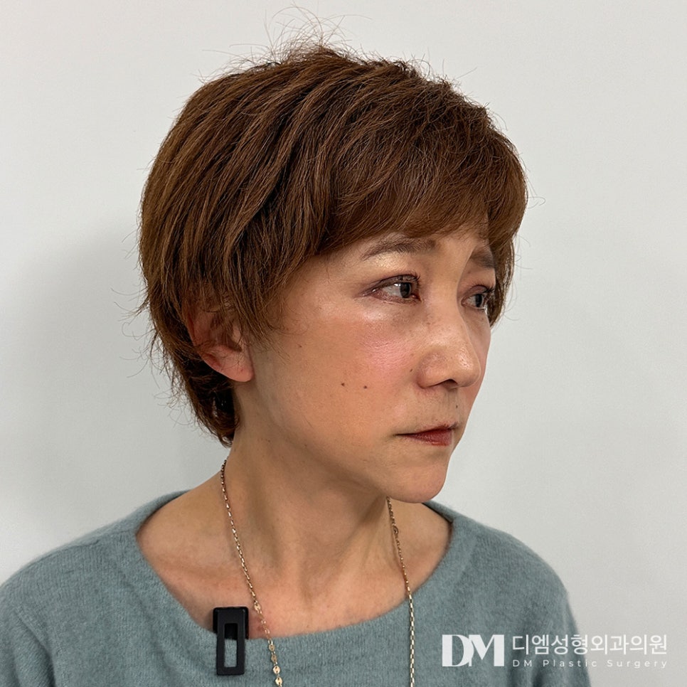 안면거상, 노화로 인한 피부처짐과 깊은 주름 개선 가능할까? 관련 이미지 16