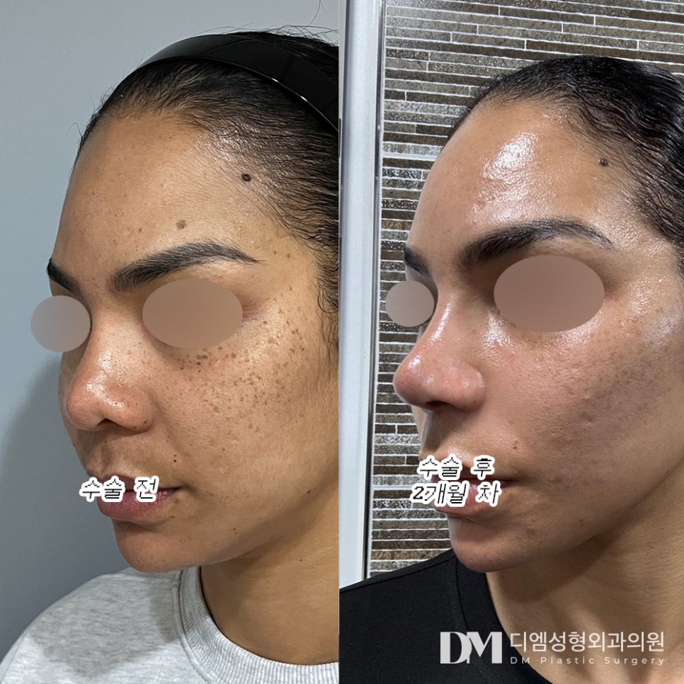 Revision Rhinoplasty: A Better Result Comes from Identifying the Cause of the First Surgery First! image 10