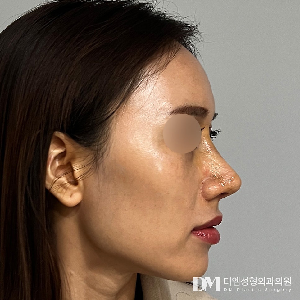 DM Long Nose Surgery: No More Midface Proportions Stress! image 7