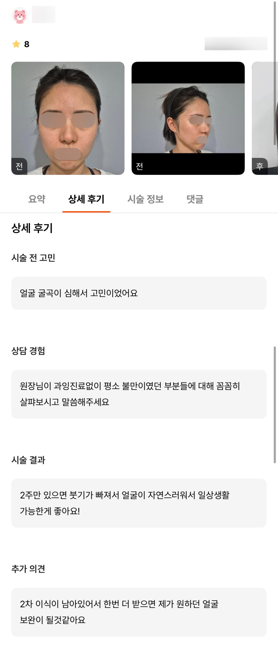 얼굴지방이식 후기."2주 후 부터 얼굴이 자연스러워서 일상 생활 가능한게 좋아요!" 관련 이미지 1