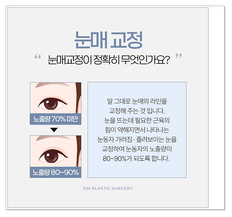 눈매교정, 피곤해보이는 인상 탈출하기 관련 이미지 5