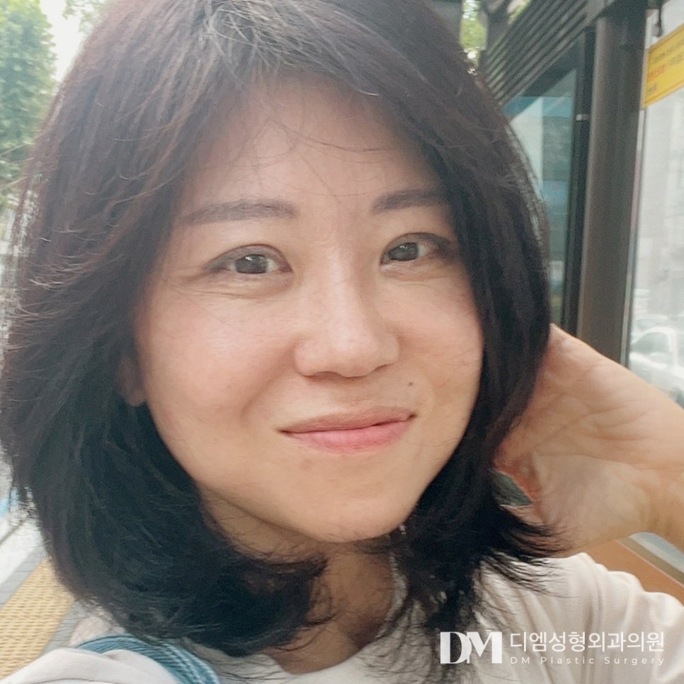 DM Facelift Before-and-After Photos: A Bright Smile Regained After Surgery, from the Forehead to the Jawline! image 3