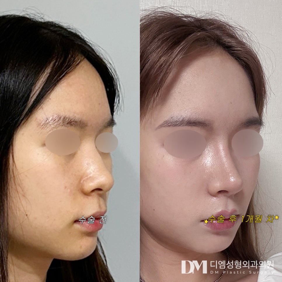 코성형 후기."일주일 후부터 완전 만족이요!" 관련 이미지 2