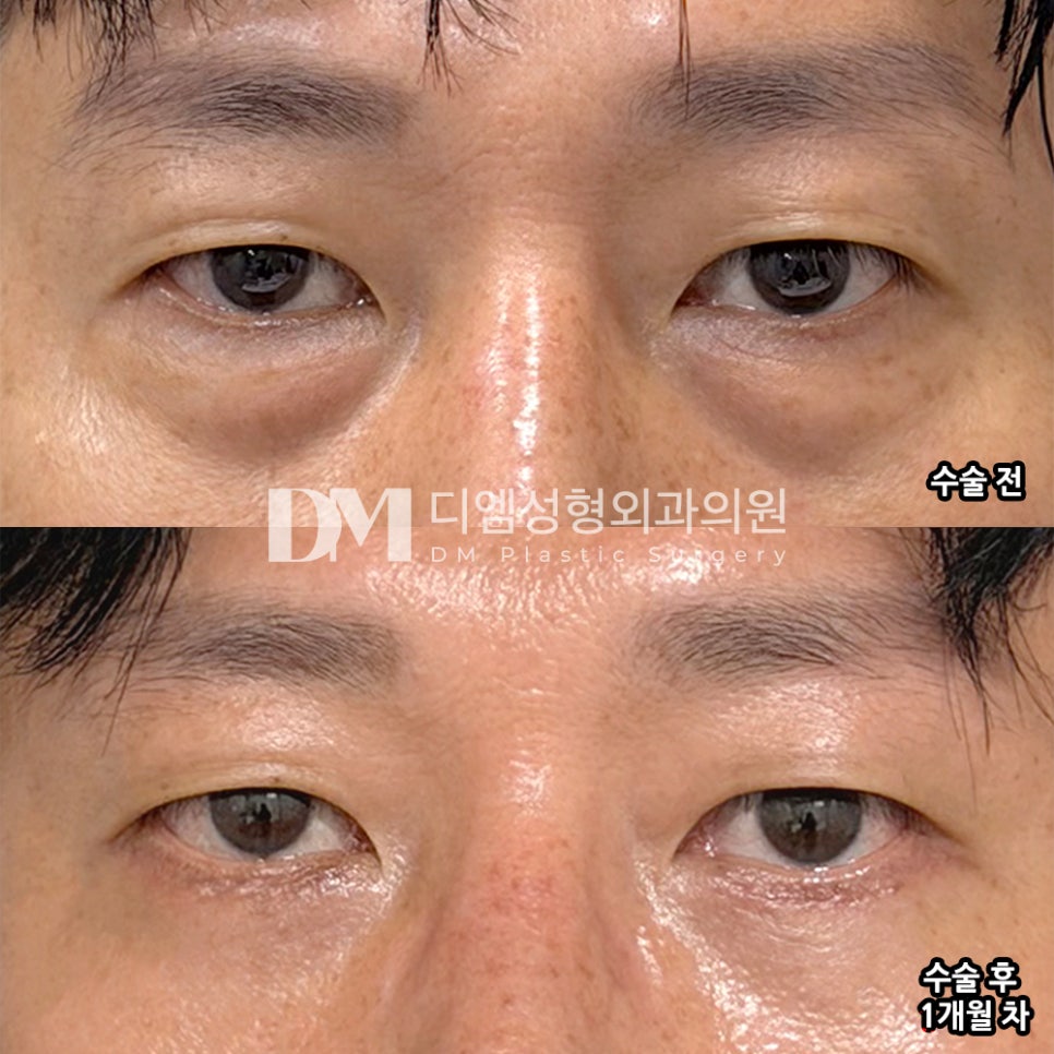DM Lower Blepharoplasty Surgery Review, “I’m Satisfied with the Results at a Reasonable Price!” image 2