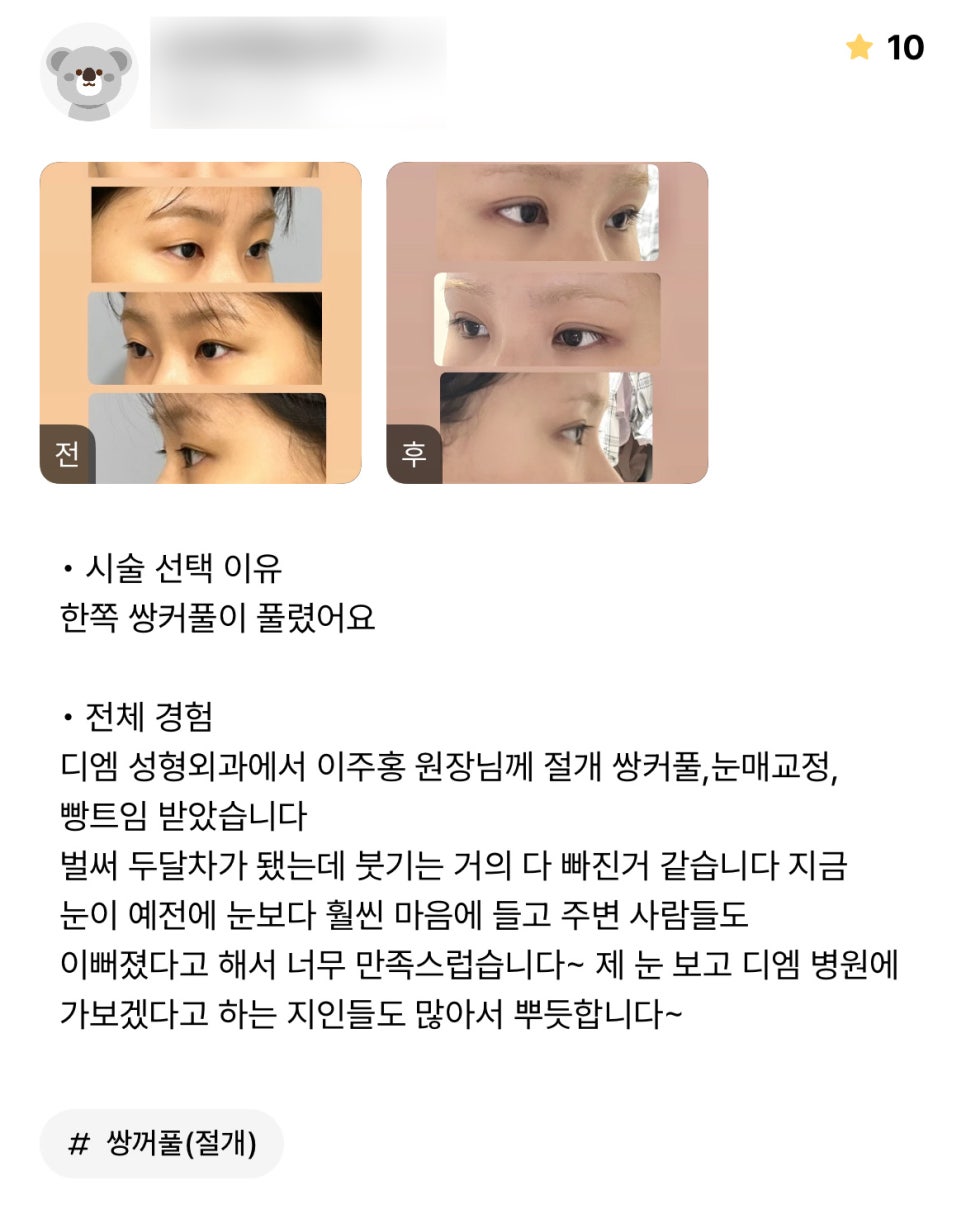 눈성형 후기."주변에서 이쁘다고해서 너무 만족스러워요!" 관련 이미지 1