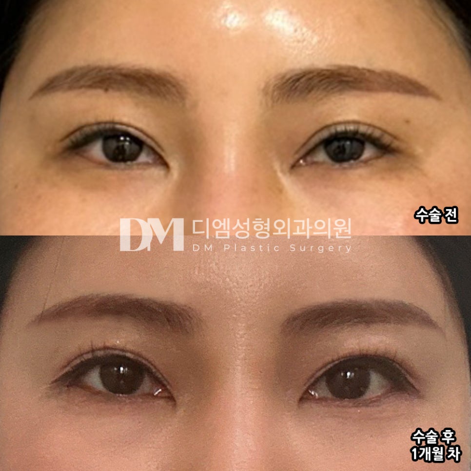 빵트임 후기."눈이 달라지니 전체적인 분위기도 달라진 것 같아서 수술하기 잘한 것 같아요." 관련 이미지 2