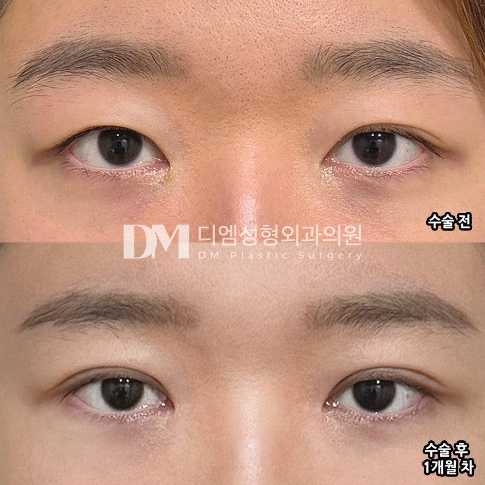 디엠 눈재수술 후기, “절개 수술 후 붓기가 빨리 빠졌어요!” 관련 이미지 2