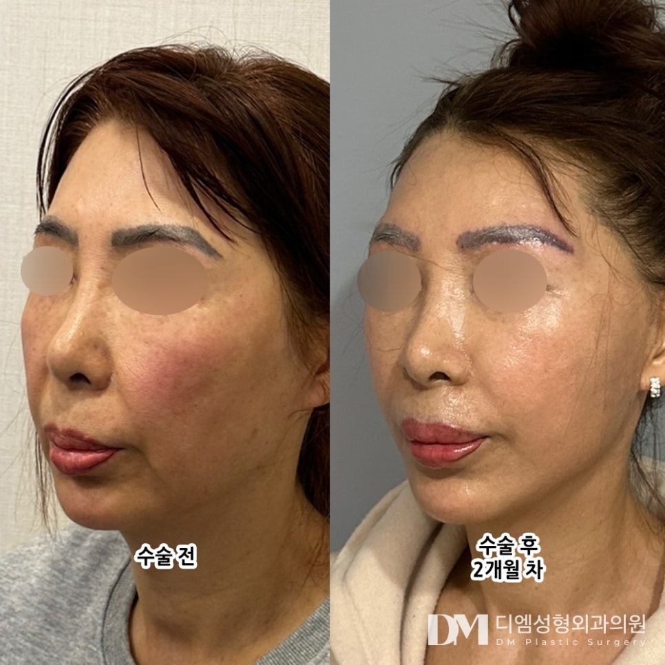 Facelift Surgery: The Key Is Creating a Plan Tailored to Each Individual’s Characteristics! image 6