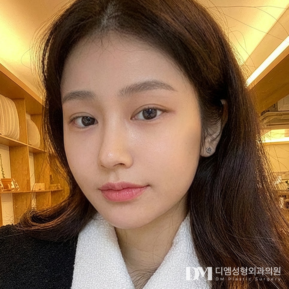 디엠 눈밑지방재배치 전후사진, 볼록한 눈 밑을 매끄럽게! 관련 이미지 1