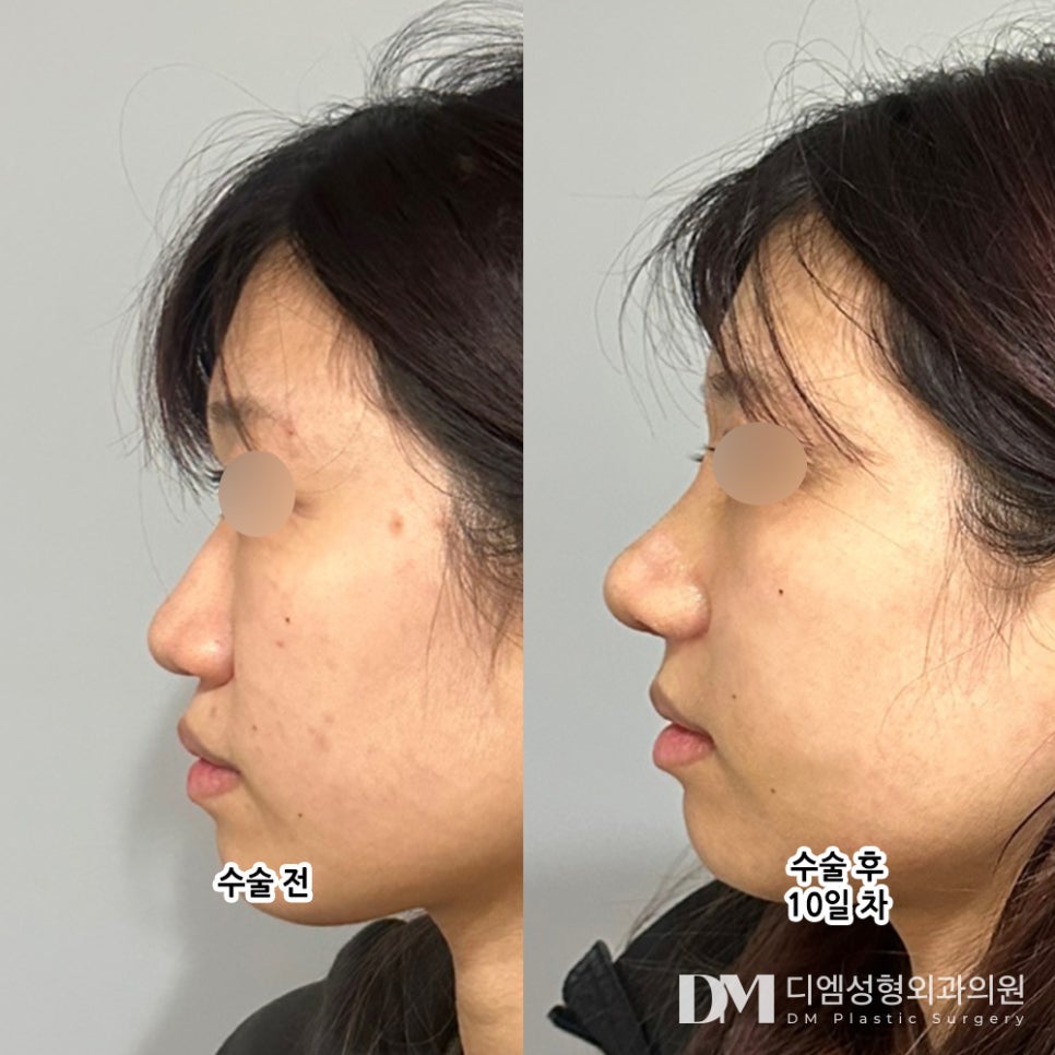 긴코,화살코 성형 짧은 중안부가 대세! 관련 이미지 6