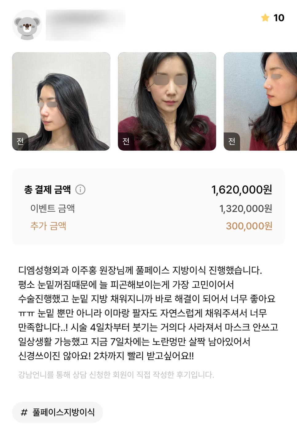얼굴지방이식 후기."고민이던게 바로 해결되어서 너무 좋아요!" 관련 이미지 1