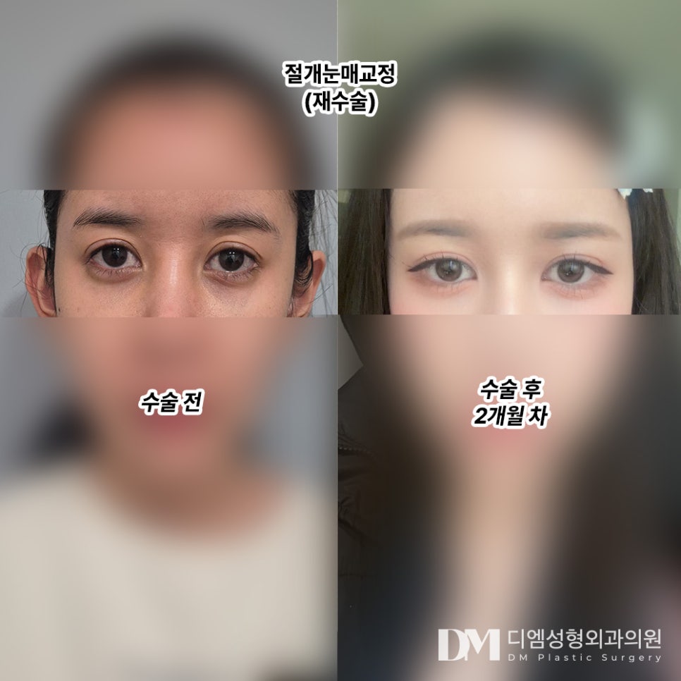 Eye Revision Surgery Review: “I’m happy that it turned out with the look I wanted!” image 2