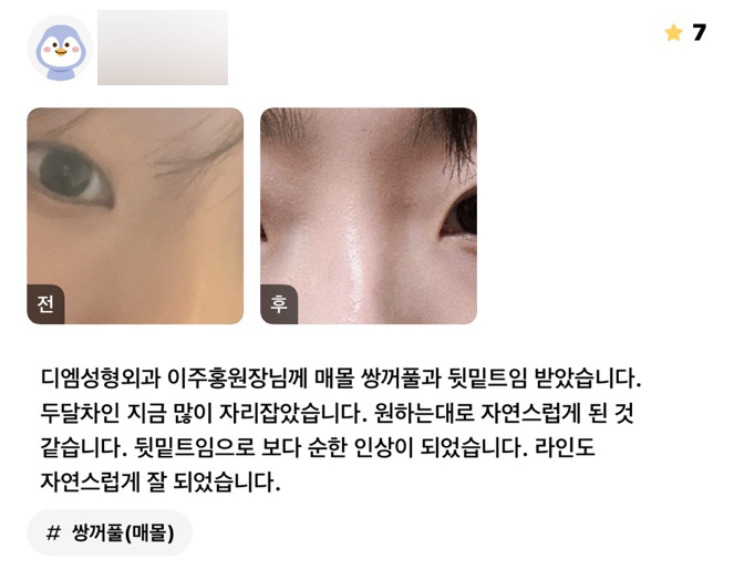눈성형 후기." 뒷밑트임으로 보다 순한 인상이 되었습니다." 관련 이미지 1
