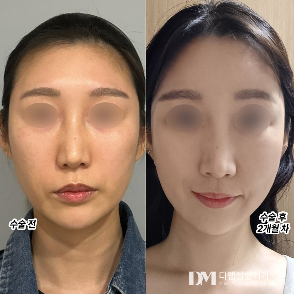 Face Fat Grafting Review. "After the second procedure, the fat has naturally taken hold, and I am satisfied with the results." image 2
