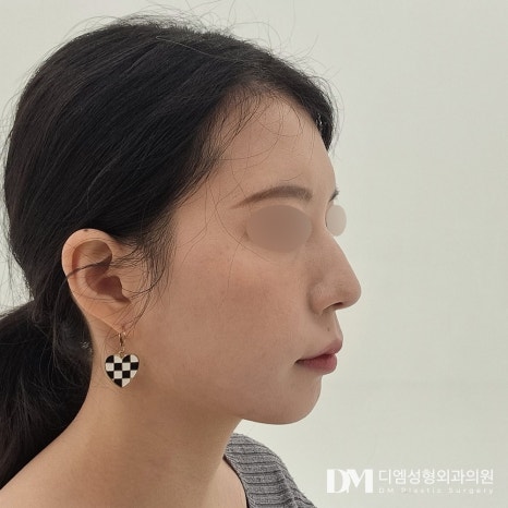 얼굴지방이식 후기."지방이식한 이후로 고민인 부분들이 채워져서 좋았어요!" 관련 이미지 3