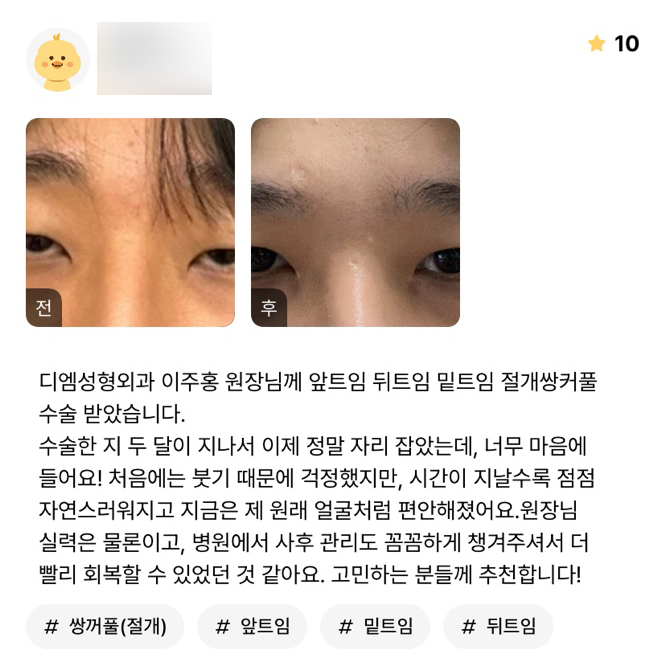 Eyelid Surgery Review: “It’s becoming more natural, and it feels as comfortable as if these were my original eyes!” image 1