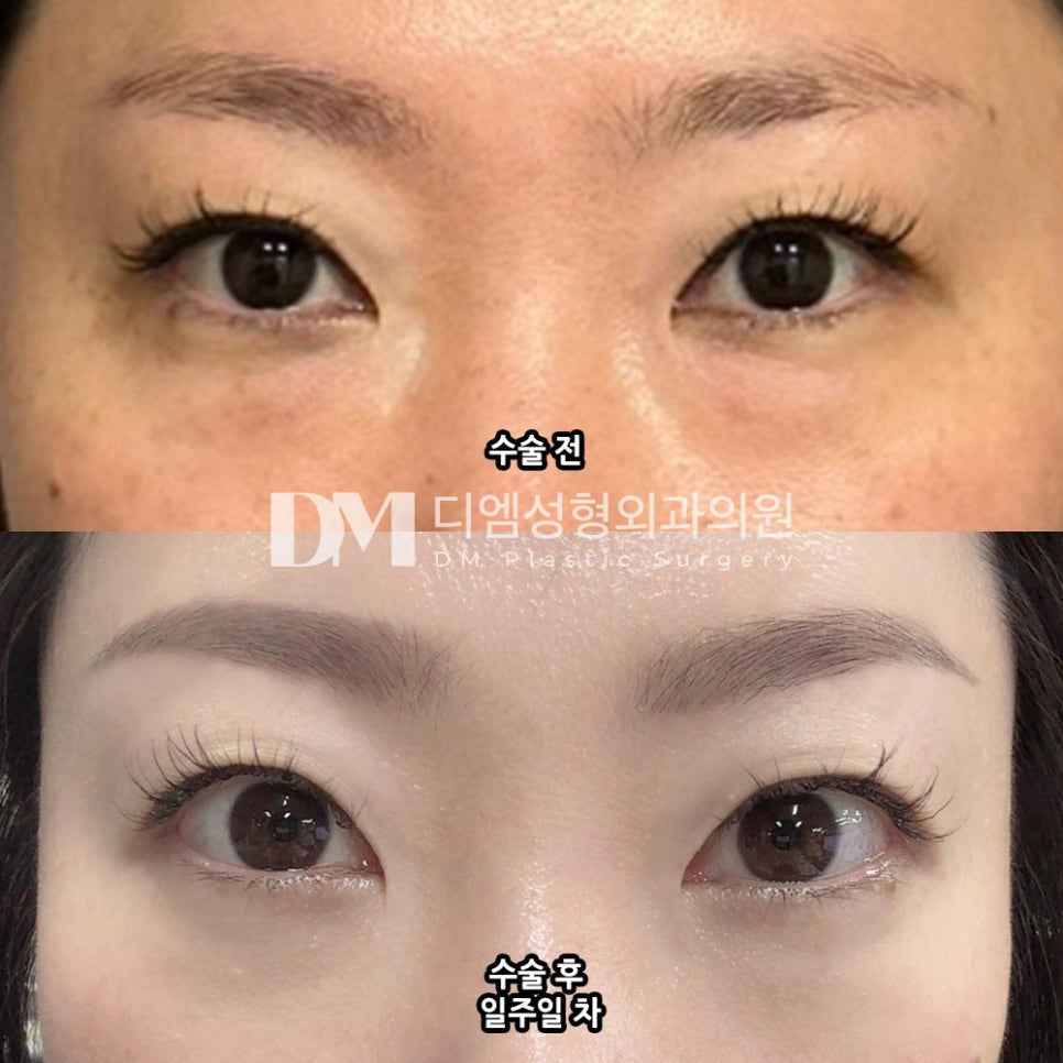 눈밑지방재배치, 노안 이미지와 피곤한 인상이 고민이라면 관련 이미지 6