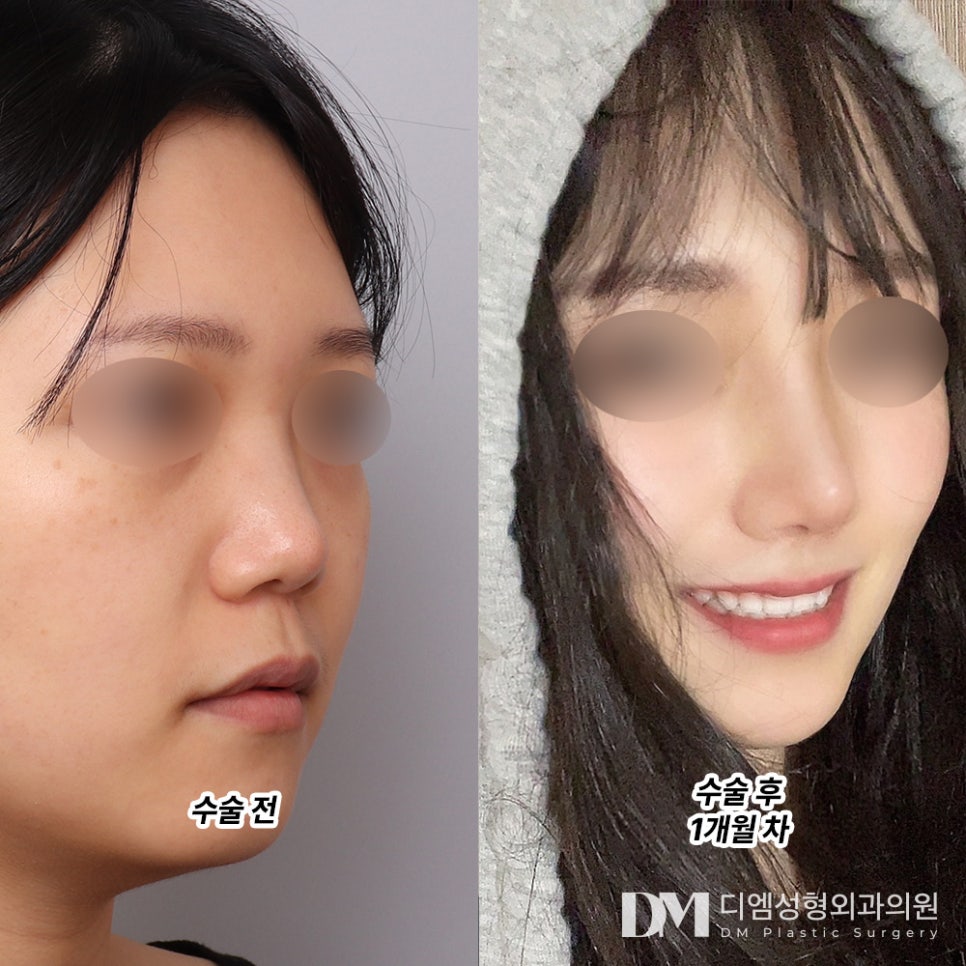A low nose, naturally balanced to match your facial proportions image 8