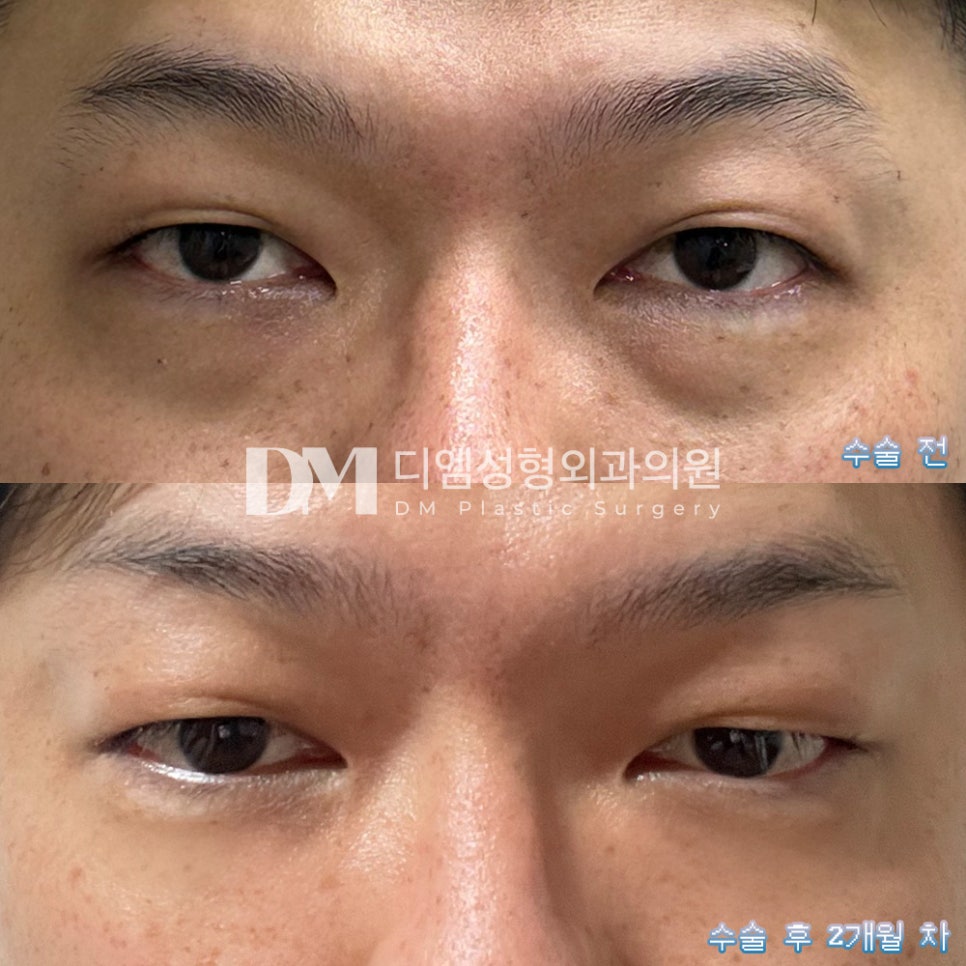 눈밑지방재배치 후기."2개월이 지난 지금 너무 만족합니다!" 관련 이미지 2