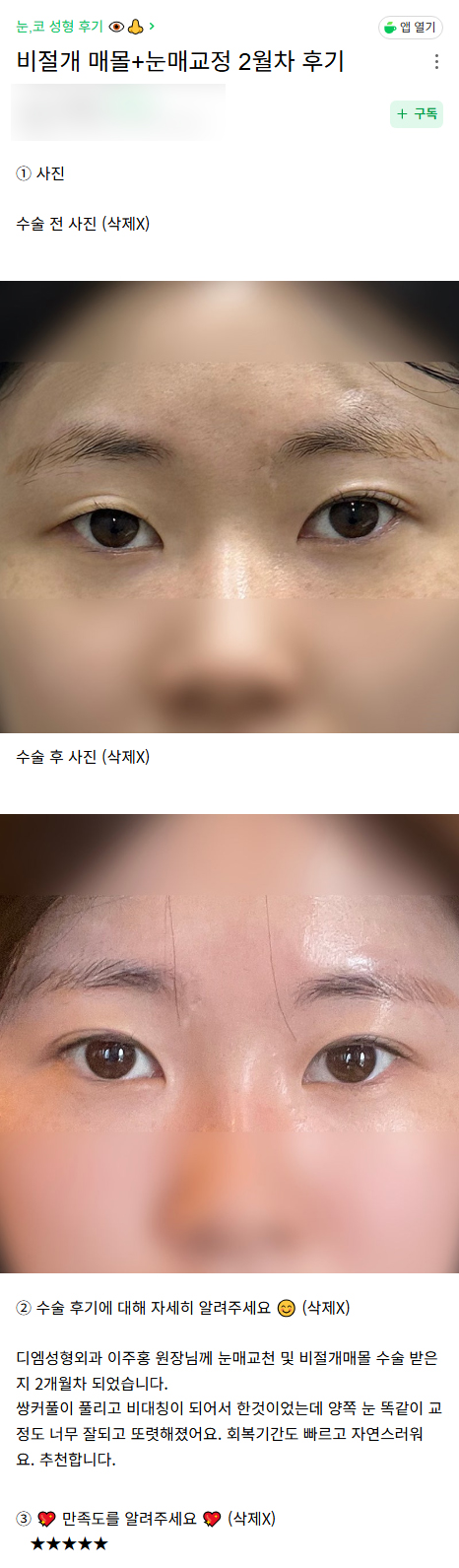 DM Revision Eyelid Surgery/Eye Shape Correction Review, &ldquo;The correction turned out so well, and my eyes look more defined!&rdquo; image 1