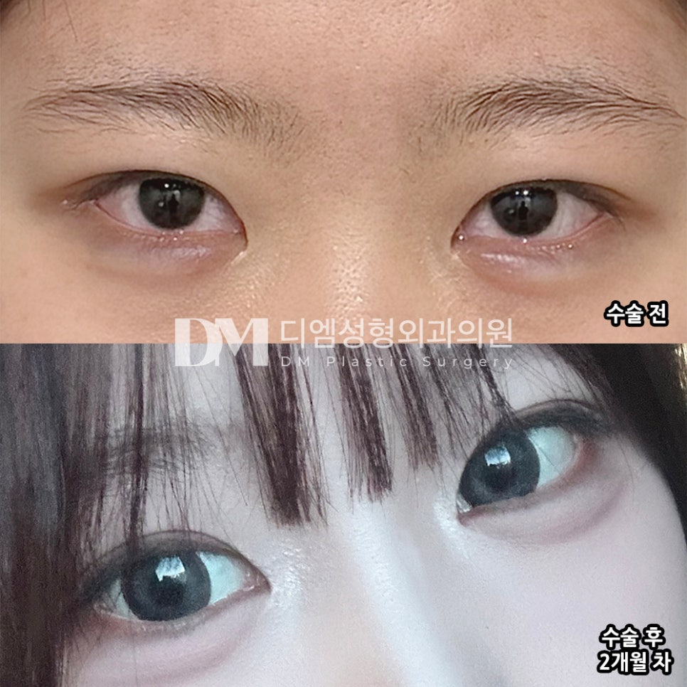 디엠 눈재수술 전후사진, 불만족스러운 쌍꺼풀 고민 끝! 관련 이미지 2