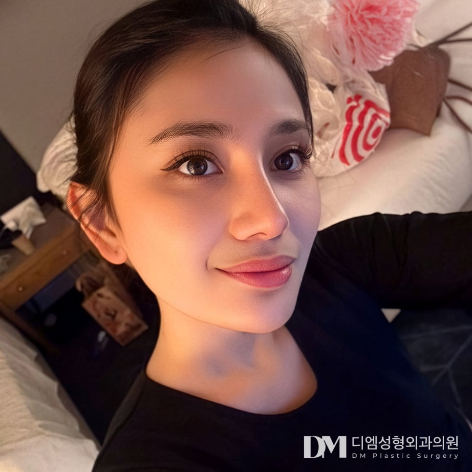 디엠 눈재수술 전후사진, 1차 수술의 실패 원인 분석 후 맞춤 수술이 중요! 관련 이미지 1