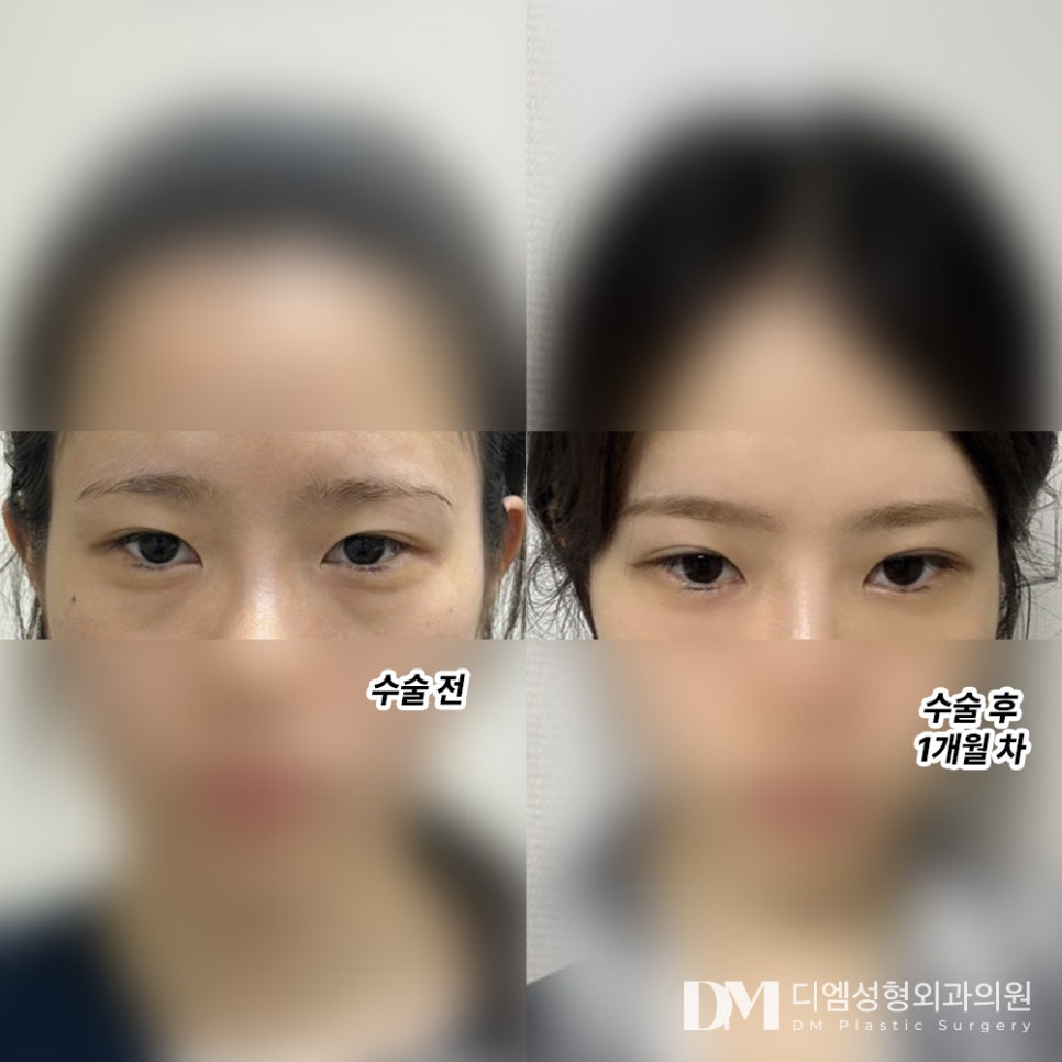 눈재수술 후기."1개월 차 인데 완전 자연스러워 졌어요!" 관련 이미지 2