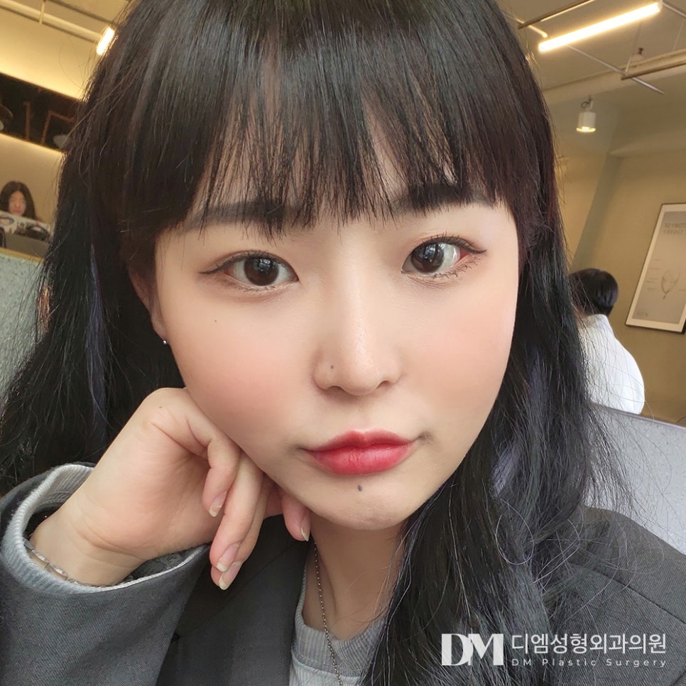 Bbangtwin: Back corner and lower corner eye surgery at the same time! image 9