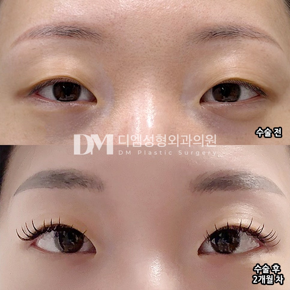 디엠 뒤밑트임/트임성형 후기, “불편한 것도 없이 너무 만족하고 있습니다!” 관련 이미지 2
