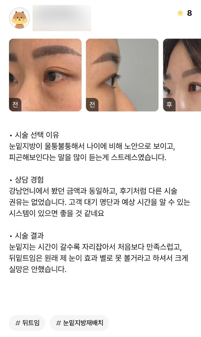 눈성형 후기."시간이 갈수록 자리 잡으니 만족스러워요!" 관련 이미지 1