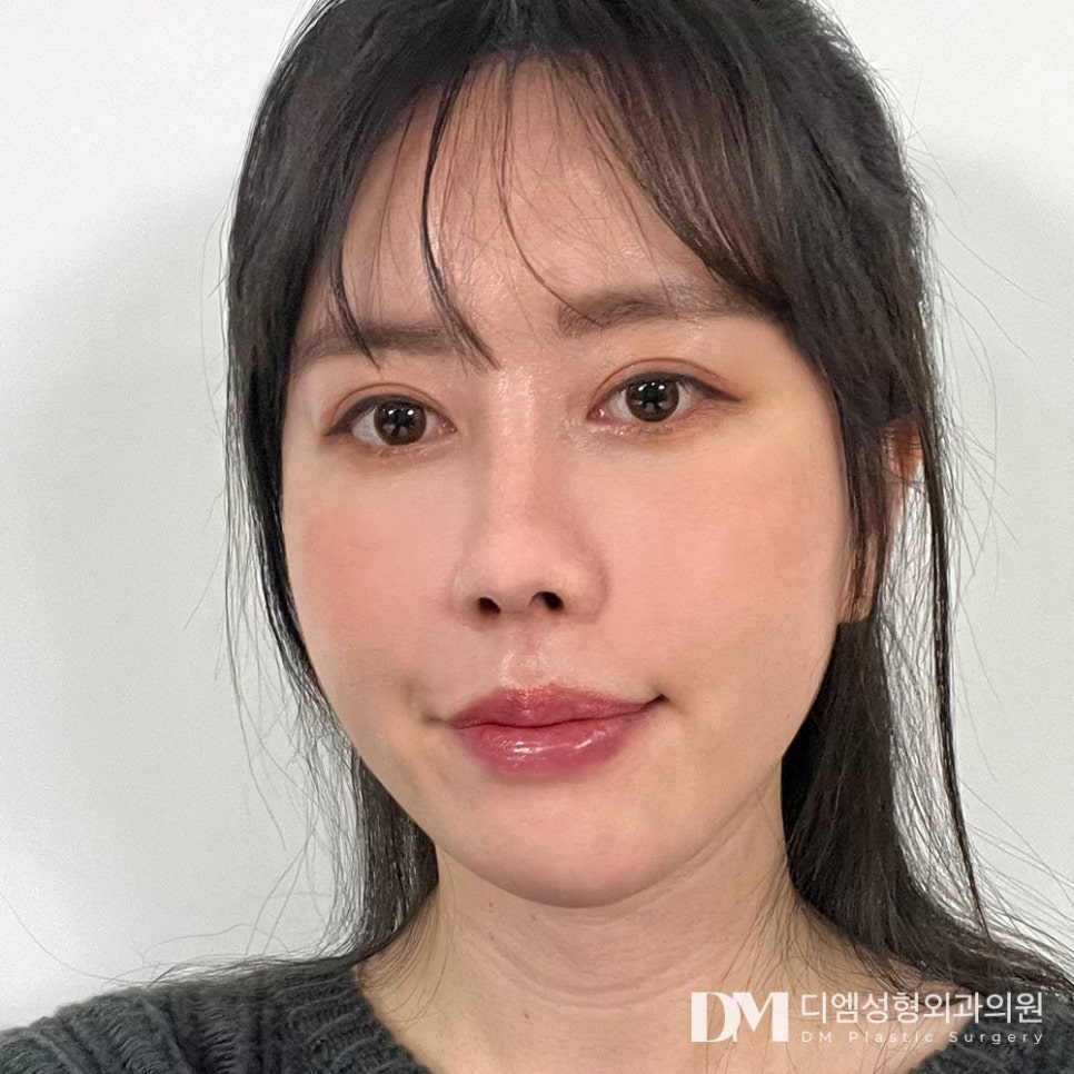 Double Eyelid Surgery: A Customized Line That Suits My Eyes image 14