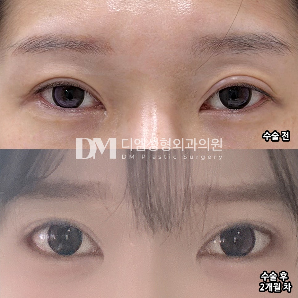 DM Eye Revision Surgery/Lateral and Lower Canthoplasty Revision Review, “I’m Very Satisfied with the Results!” image 2