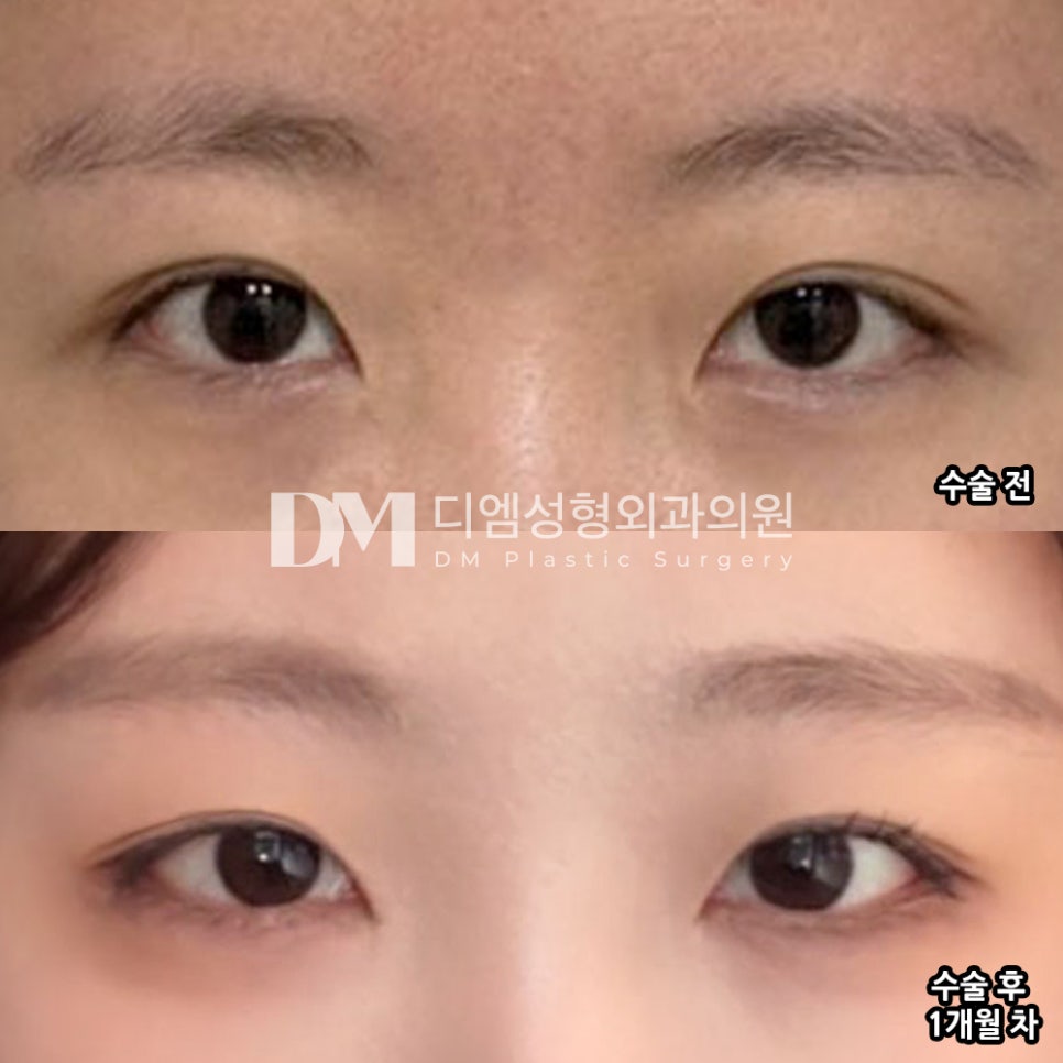 DM Outer-Corner Eye Widening Surgery Review, “Recommended for Those Who Prefer a Natural Look!” image 2