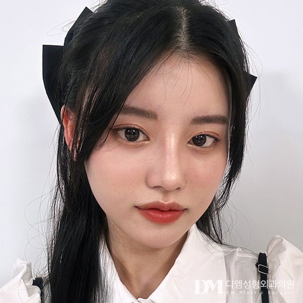 코성형 후 피노키오 코처럼 보이는 이유, 코가 높아서일까요? 관련 이미지 9