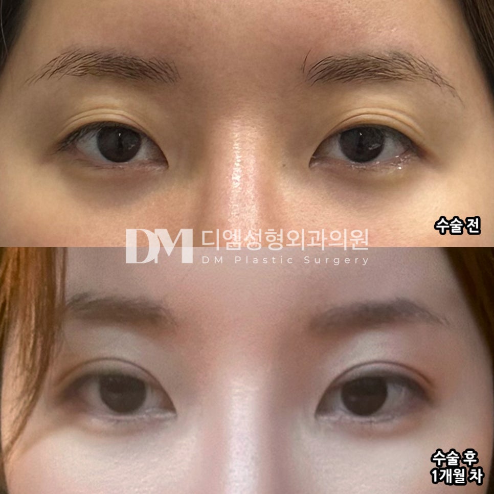 눈재수술 후기."말하지 않으면 모를 정도로 자연스러워요!" 관련 이미지 2