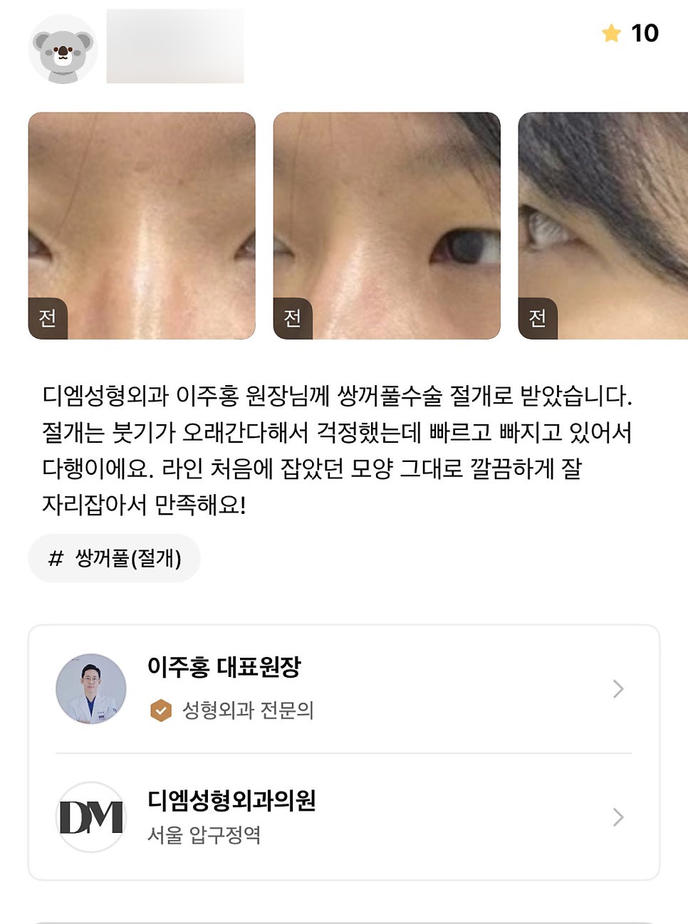 눈성형 후기."처음 라인 그대로 깔끔하게 자리잡아서 만족해요!" 관련 이미지 1