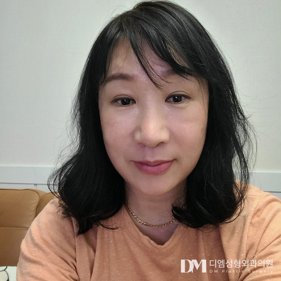 Partial facelift, naturally and without overdoing it! image 14