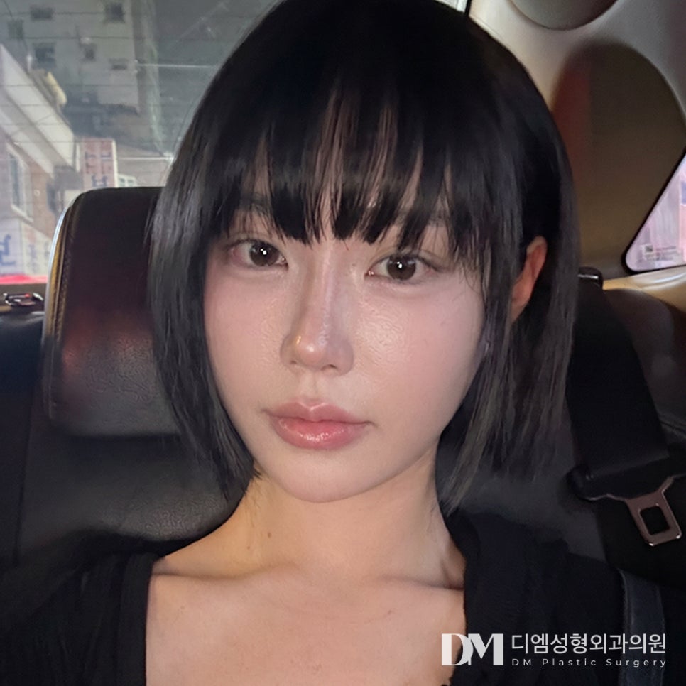 디엠 눈재수술 전후사진, 첫 수술 실패 원인부터 찾아야 합니다! 관련 이미지 3