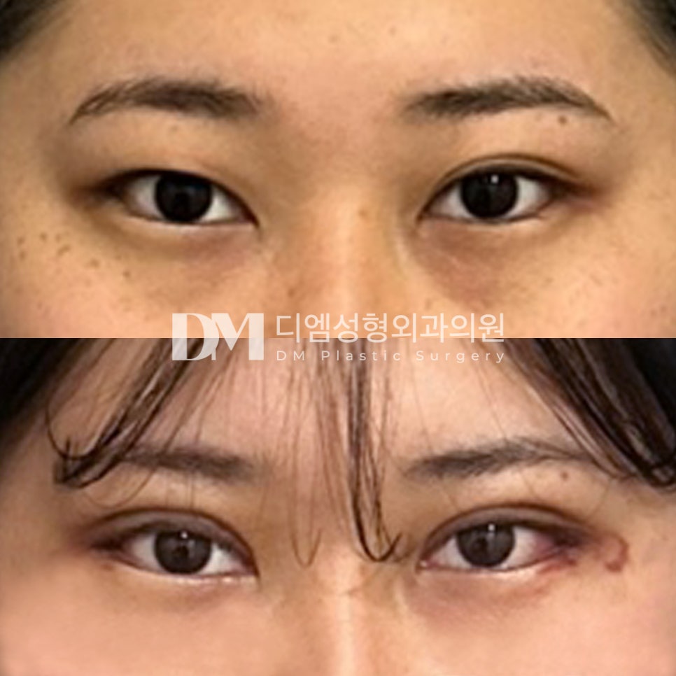 눈성형 후기."눈이 커지니 세상이 잘보여요!" 관련 이미지 2