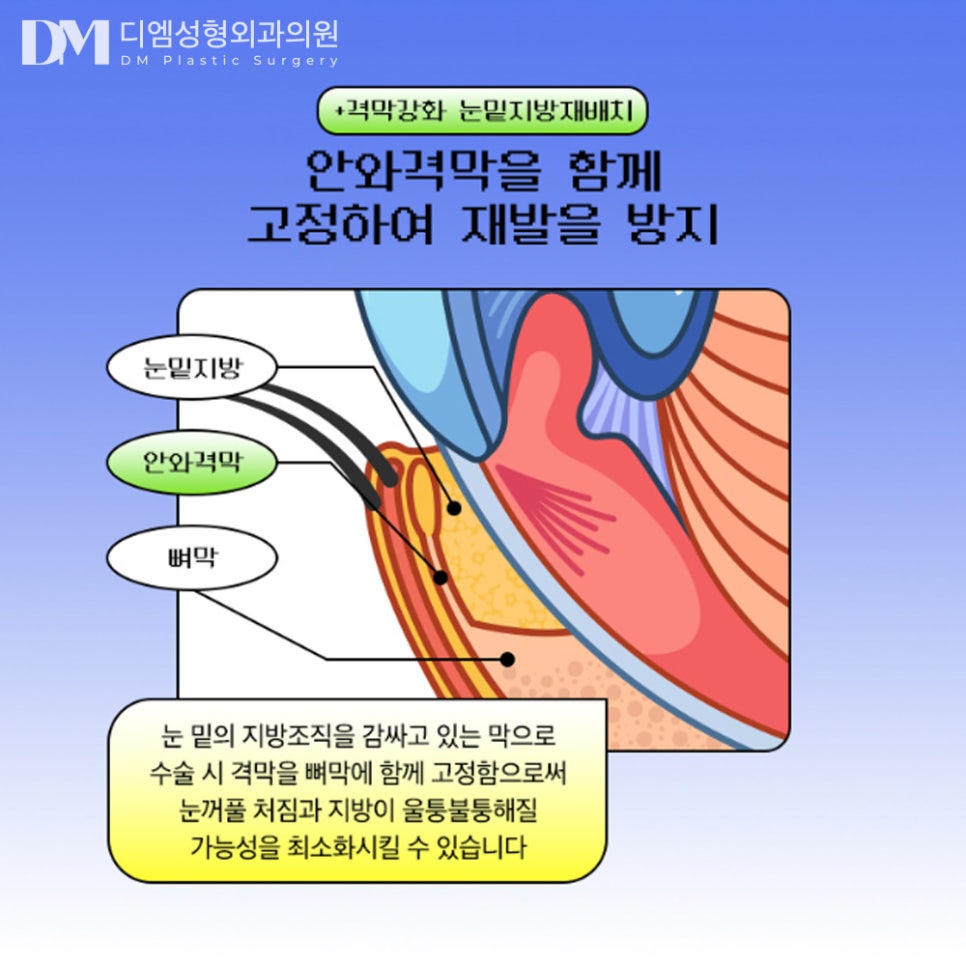 눈밑지방재배치, 불룩해진 눈밑 매끈하게 되살리기! 관련 이미지 5