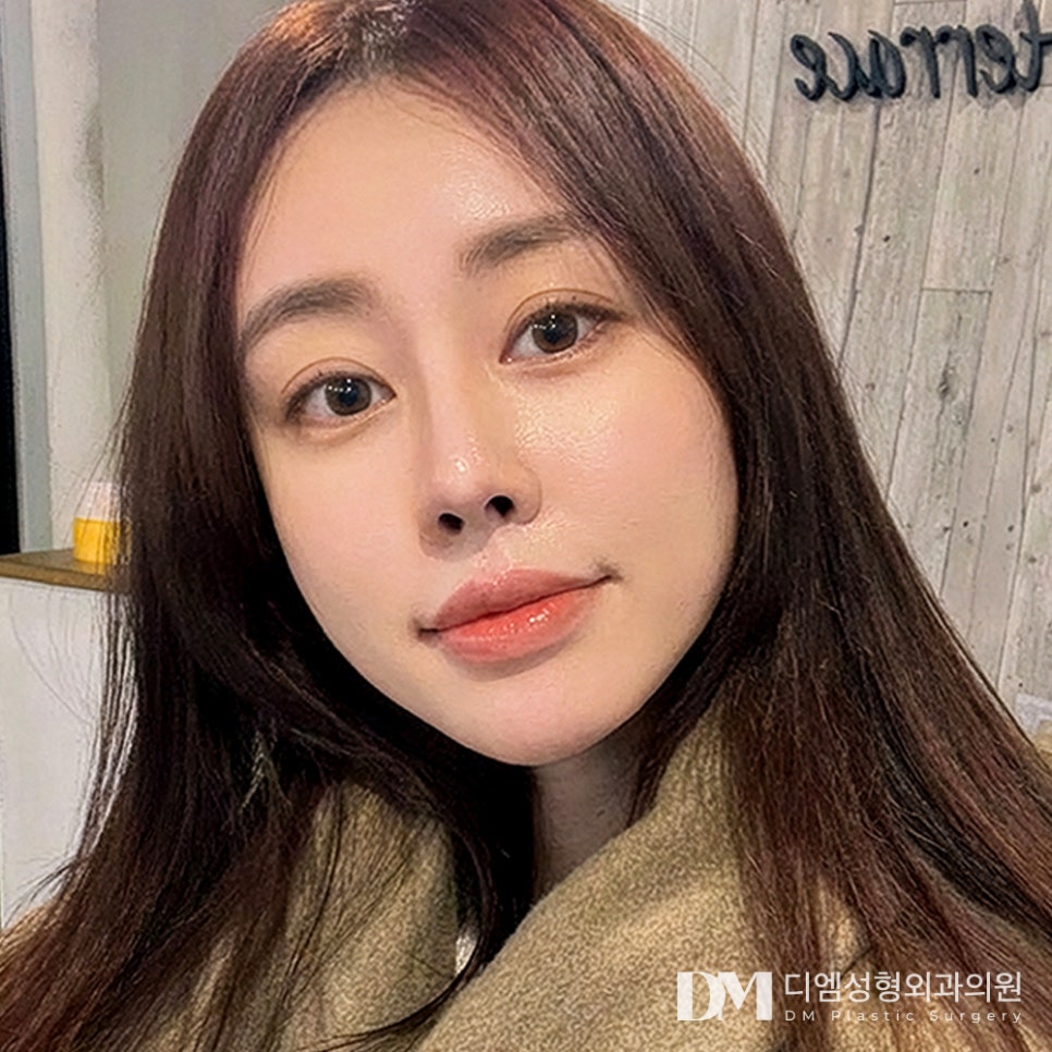 디엠 얼굴지방이식 전후사진, 얼굴에 볼륨을 더하면 생기는 변화 관련 이미지 3