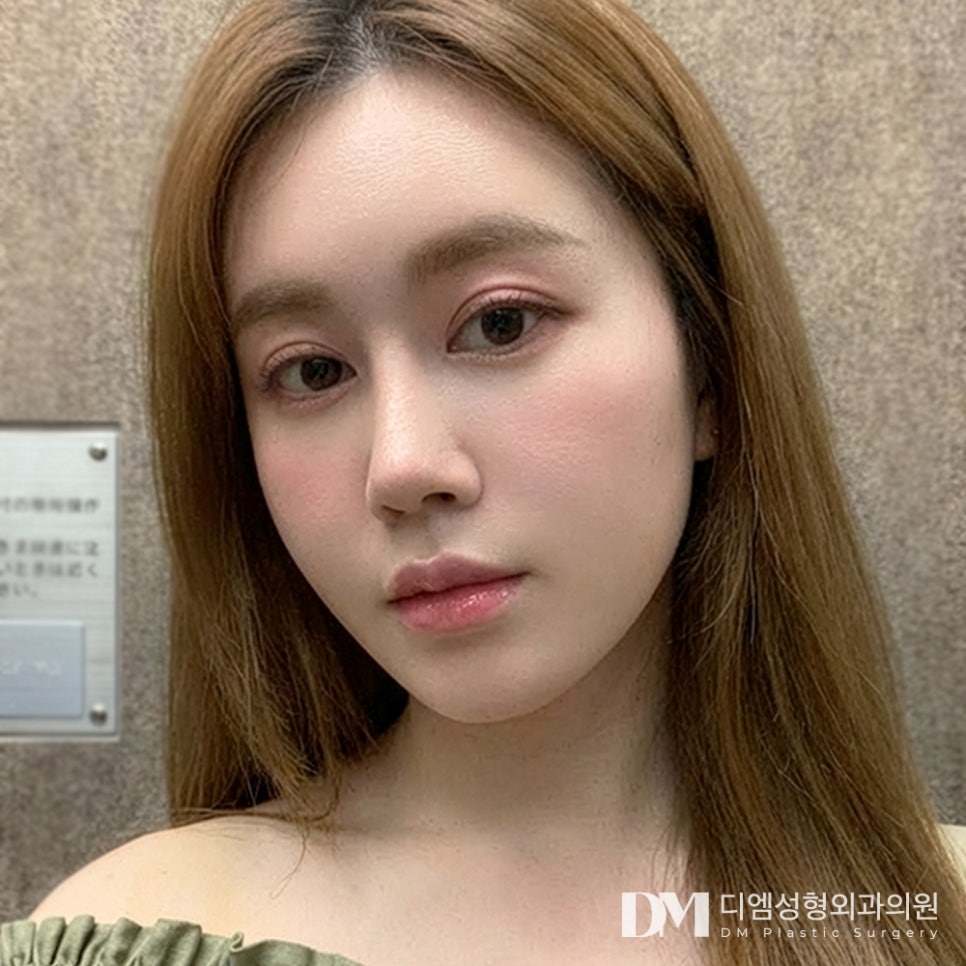디엠 뒤밑트임 전후사진, 자연스럽게 눈매 확장을 원한다면! 관련 이미지 1