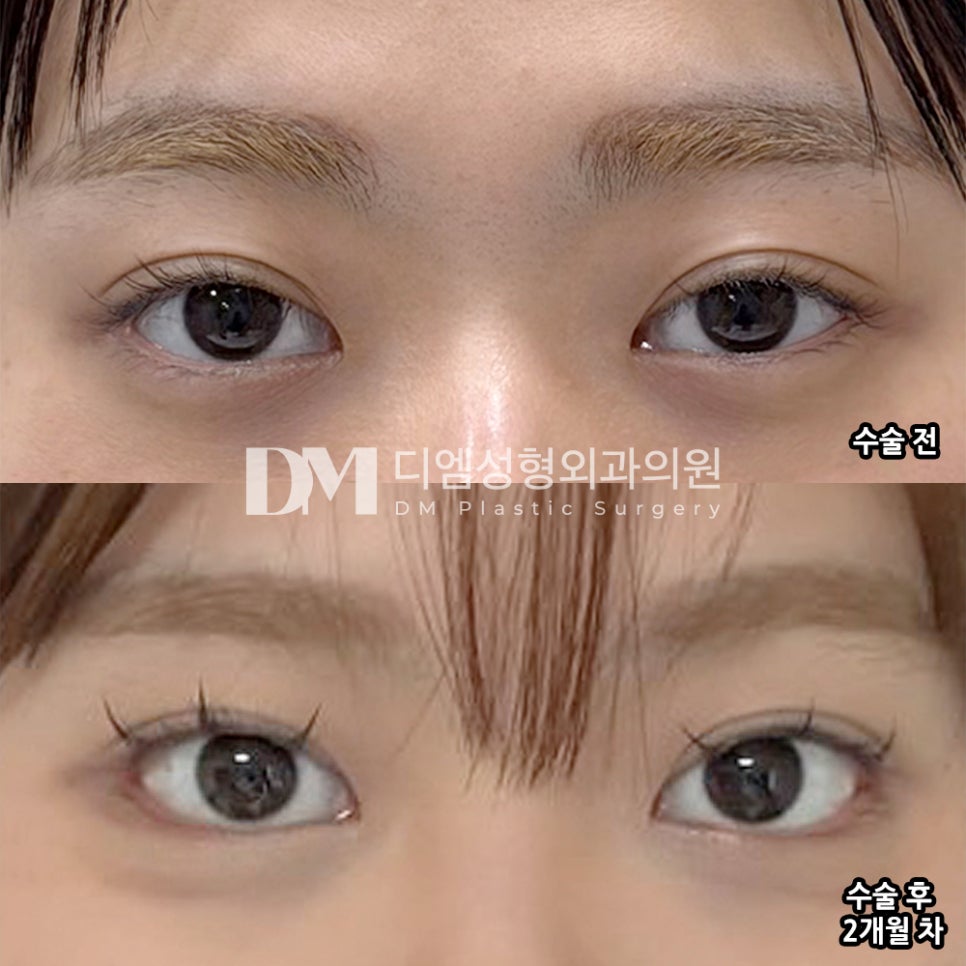 DM Lateral and Lower Canthoplasty Surgery Review, &ldquo;I’m Very Satisfied That It Opened Up Exactly as Much as I Wanted!&rdquo; image 2