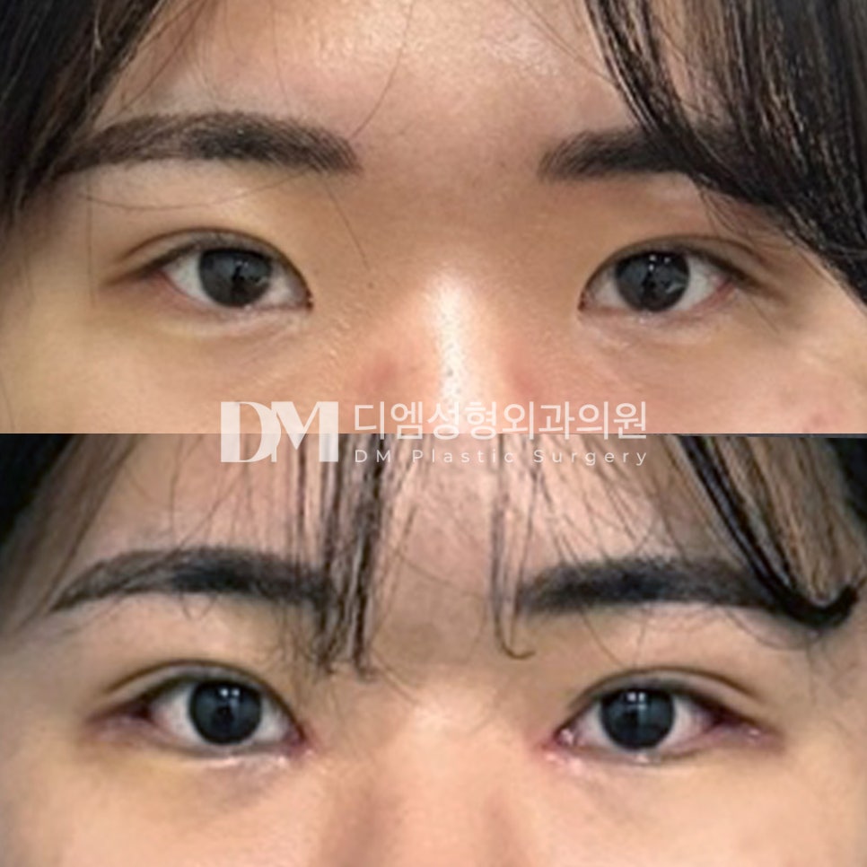 Canthoplasty Review. “I’m definitely satisfied because my eyes look naturally more open!” image 2