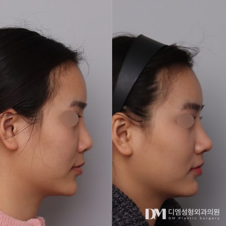 코재수술 , 반복하고 싶지 않다면? 관련 이미지 11