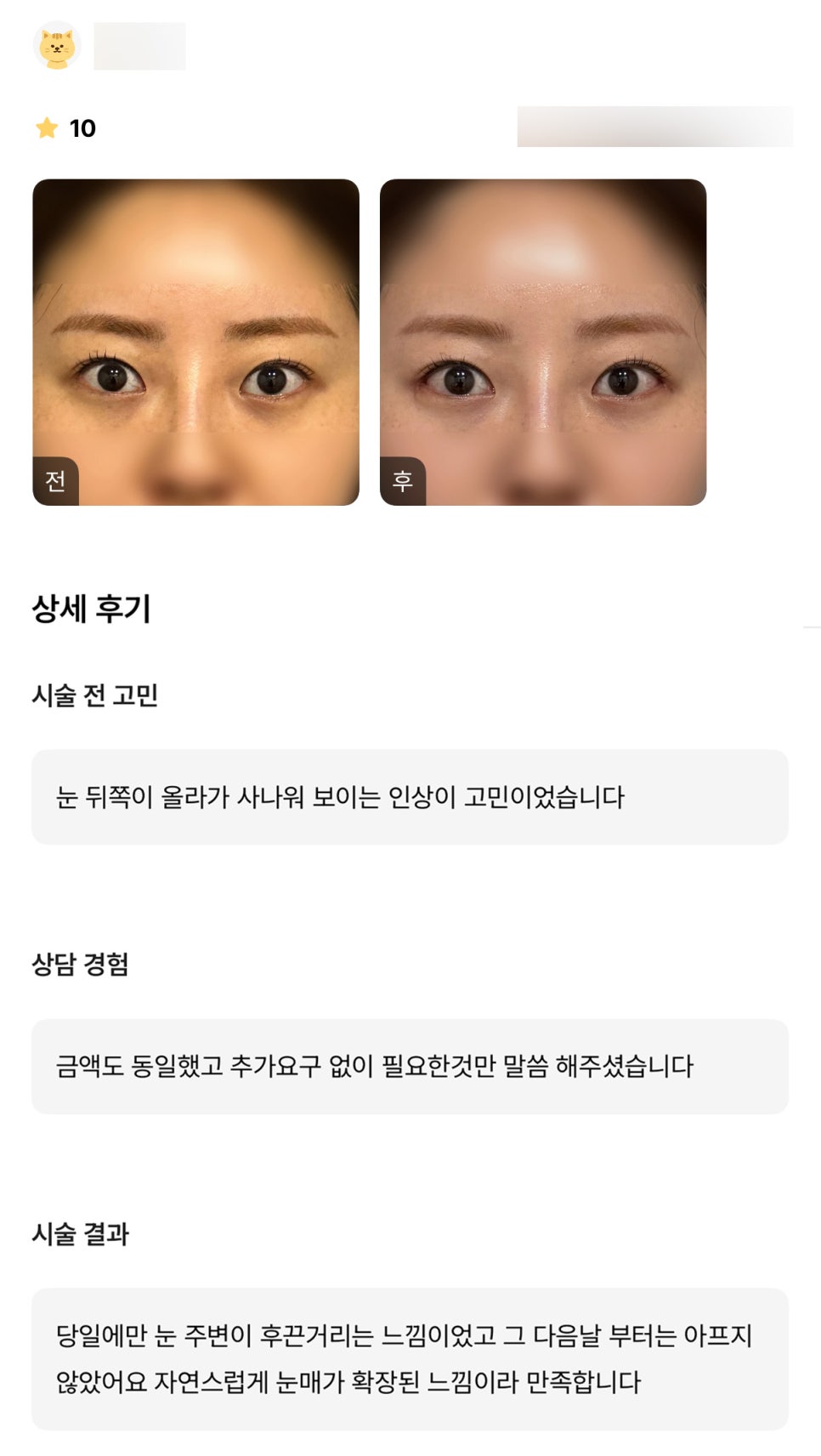 Lower Outer Canthoplasty Review. "I’m satisfied because it feels like my eye shape has been naturally widened!" image 1
