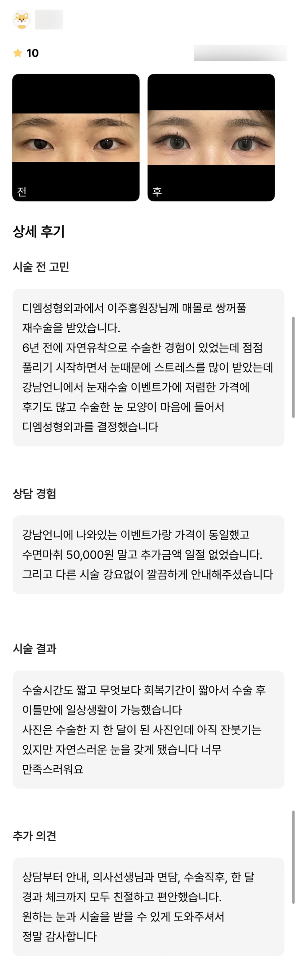 눈재수술 후기."자연스러운 눈을 가지게 되어 너무 만족스러워요!" 관련 이미지 1