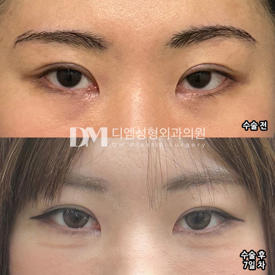 뒤밑트임, 흉터없이 순한 눈매로 관련 이미지 5