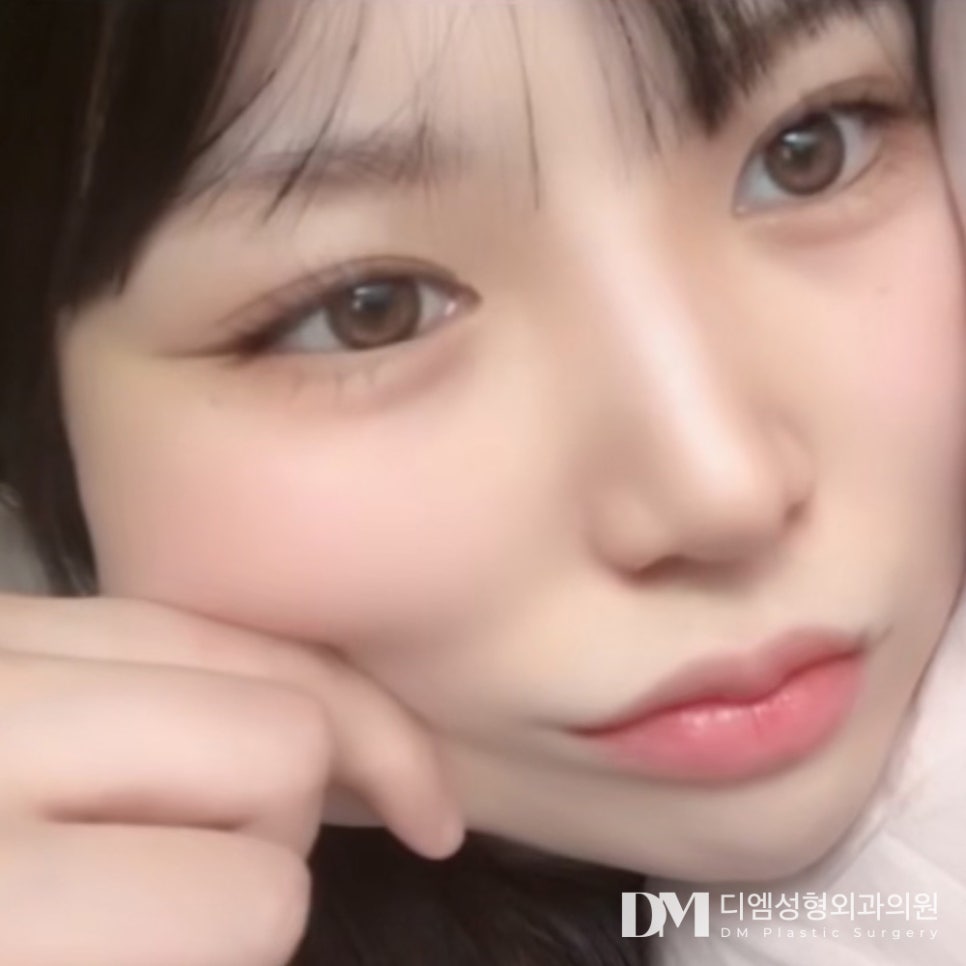 쌍꺼풀수술, 자연스럽고 부드러운 인상 만들기 관련 이미지 14