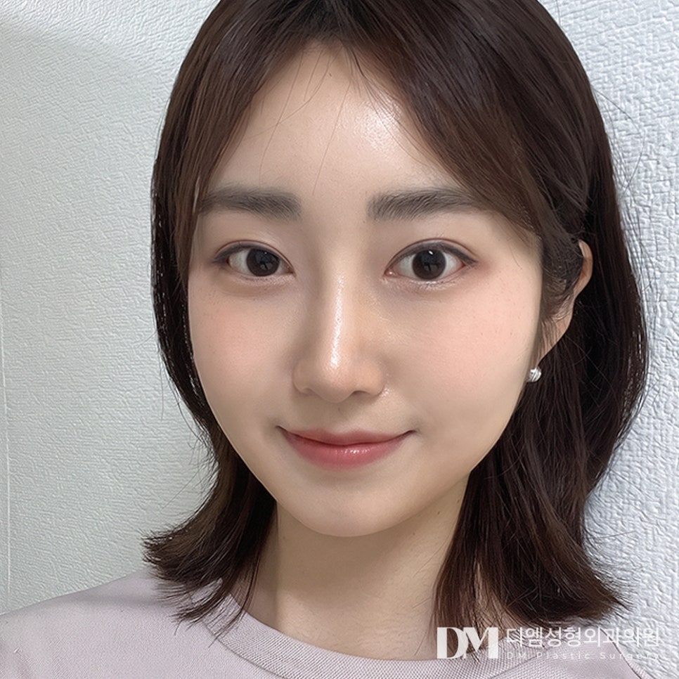 디엠 트임성형 전후사진, 전체적으로 답답한 눈매 개선 방법은? 관련 이미지 3